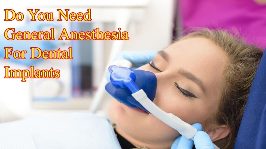 Do You Need General Anesthesia For Dental Implants
