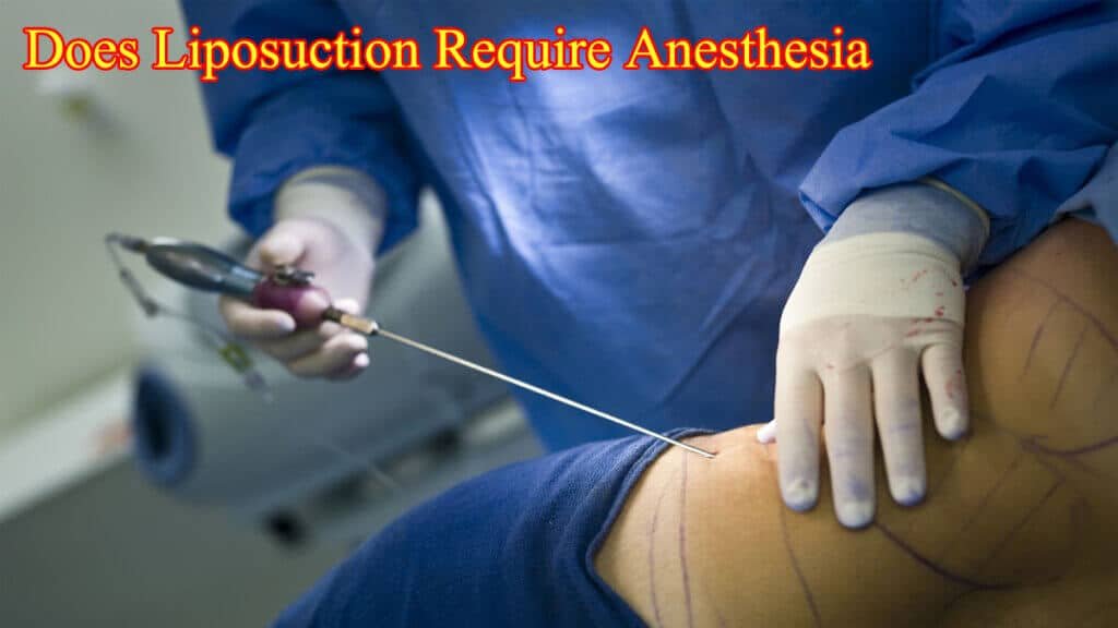 Does Liposuction Require Anesthesia