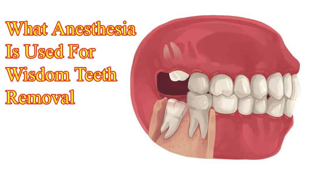 What Anesthesia Is Used For Wisdom Teeth Removal