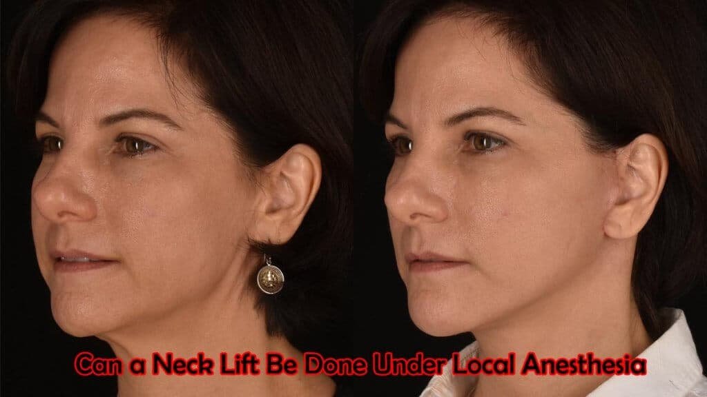 Can a Neck Lift Be Done Under Local Anesthesia